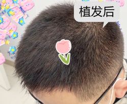 -大麦微针植发全国连锁