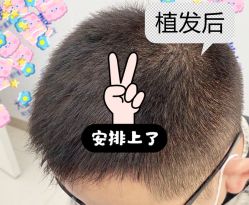 -大麦微针植发全国连锁