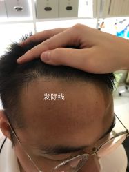 -大麦微针植发全国连锁