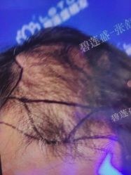 体验前-碧莲盛·不剃发植发