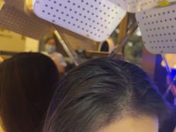 -碧莲盛·不剃发植发