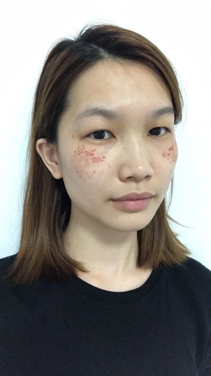 超皮秒淡斑体验后279天效果分享