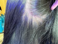 -碧莲盛·不剃发植发