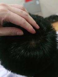 点击看大图 -碧莲盛·不剃发植发