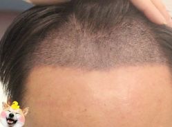 -大麦微针植发丨全国连锁