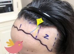 -大麦微针植发全国连锁