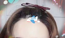 -大麦微针植发全国连锁