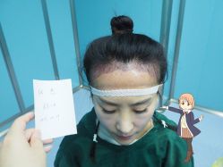 -大麦微针植发丨全国连锁