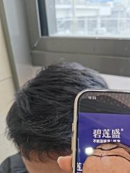 -碧莲盛·不剃发植发