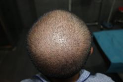 点击看大图 -大麦微针植发丨全国连锁