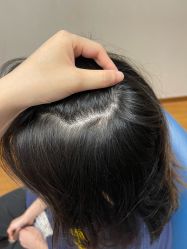 体验后-大麦微针植发全国连锁