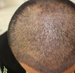 -大麦微针植发丨全国连锁