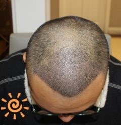 -大麦微针植发丨全国连锁