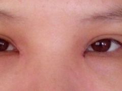 第八天-上海华安整形外科门诊部