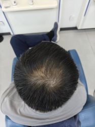 -大麦微针植发全国连锁
