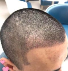 -大麦微针植发丨全国连锁