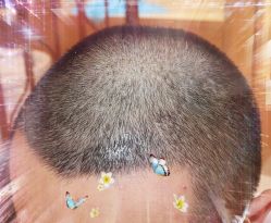 -大麦微针植发全国连锁