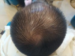 -碧莲盛·不剃发植发