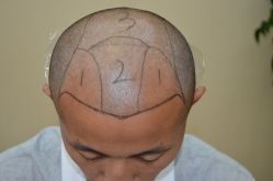 -大麦微针植发丨全国连锁