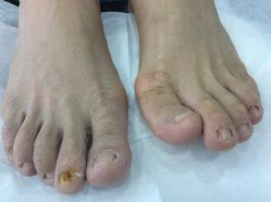 点击看大图 -德哥灰指甲脚气甲沟炎跖疣护理