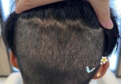 -大麦微针植发全国连锁