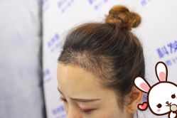 -大麦微针植发丨全国连锁