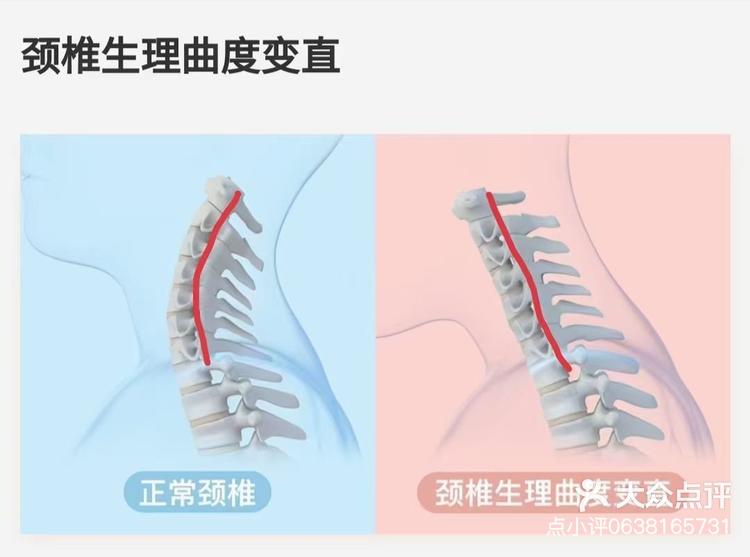 颈椎前凸消失图片