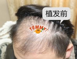 -大麦微针植发全国连锁