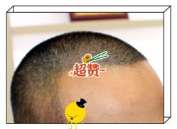 -大麦微针植发全国连锁