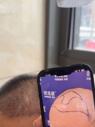 -碧莲盛·不剃发植发