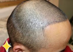 -大麦微针植发丨全国连锁