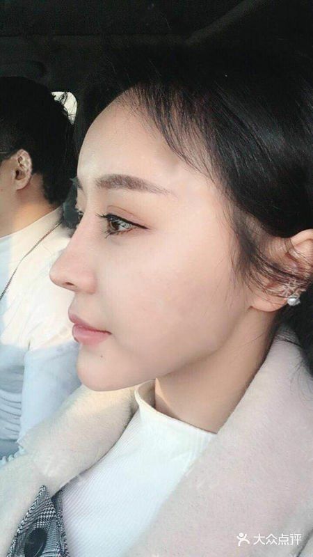 双下巴吸脂美得自然美的完美