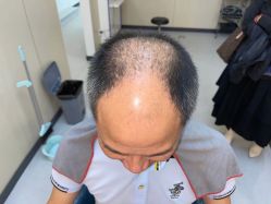 点击看大图 体验前-大麦微针植发全国连锁