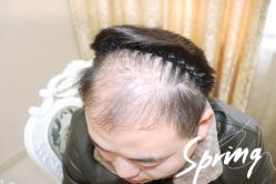 点击看大图 体验后-大麦微针植发全国连锁