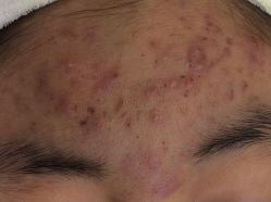 -蕾特恩专业祛痘·皮肤管理