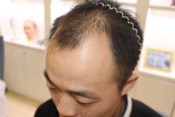 -大麦微针植发丨全国连锁