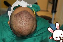 点击看大图 -大麦微针植发丨全国连锁