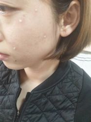 -北京美痣堂古方祛痣斑疣瘊