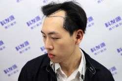 -大麦微针植发丨全国连锁