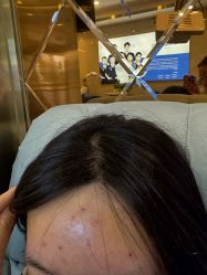 -碧莲盛·不剃发植发