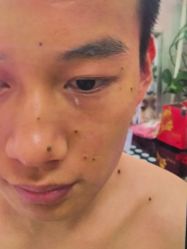 -北京美痣堂古方祛痣斑疣瘊