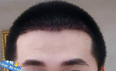 -大麦微针植发丨全国连锁