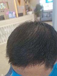 -大麦微针植发全国连锁