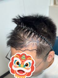 点击看大图 -大麦微针植发全国连锁