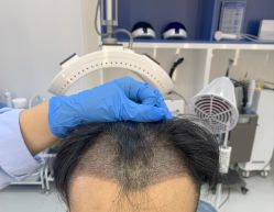 -大麦微针植发全国连锁