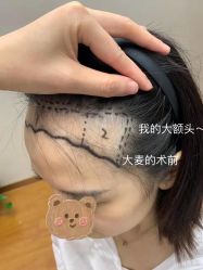 -大麦微针植发全国连锁