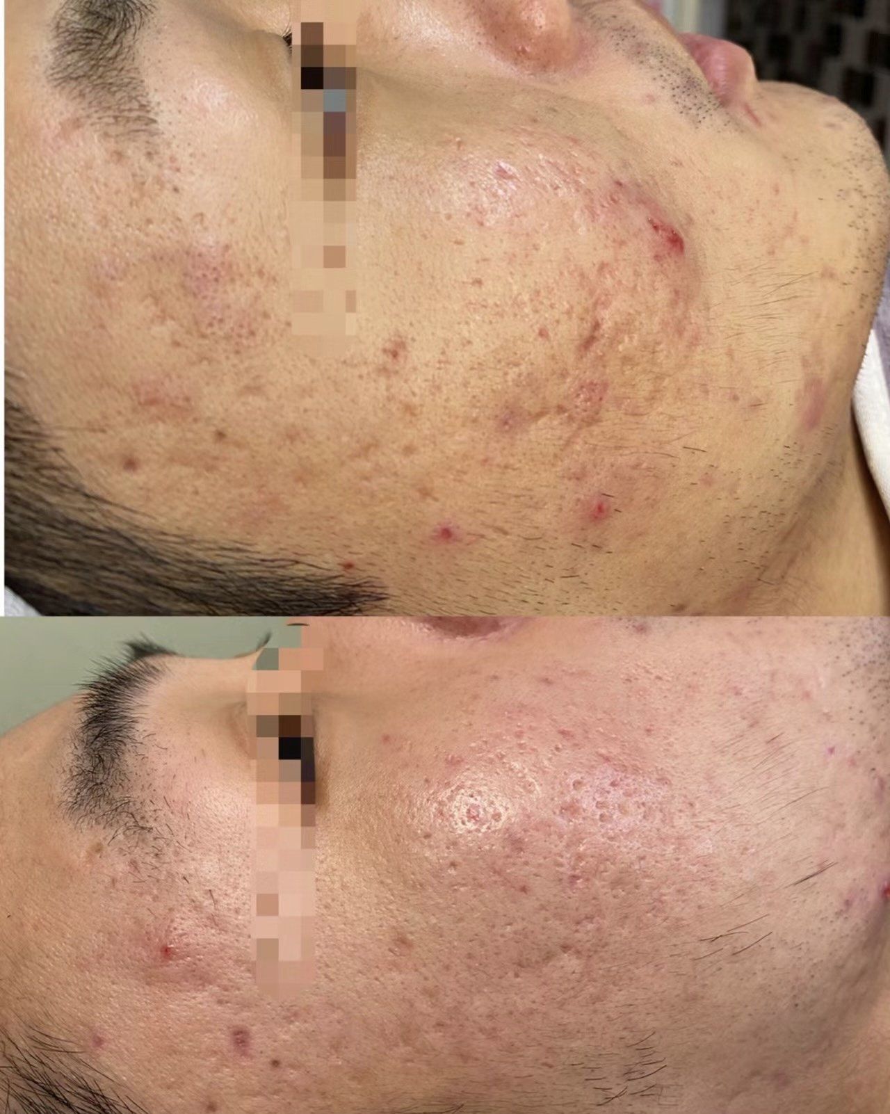 分享一下最近的痘坑痘印对比 一次效果🆚