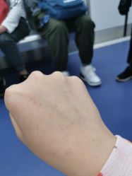 体验后-嘉和医学脱毛中心