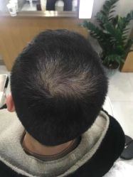 -大麦微针植发全国连锁