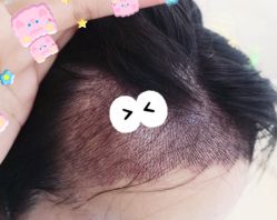 -大麦微针植发全国连锁